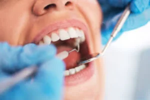 Aparelho ortodôntico invisível para alinhamento dentário Dentista em CIDADE DEZ.