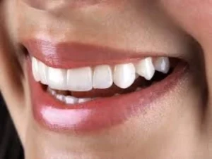 cuidados pós-clareamento dental para manter os dentes brancos e saudáveis Dentista em CIDADE DEZ.