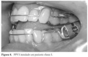Passo a passo do tratamento de canal realizado por especialistas Dentista em CIDADE DEZ
