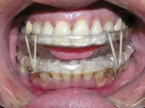 Orientação e cuidados com próteses dentárias em pacientes idosos Dentista em CIDADE DEZ