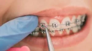 Tratamento odontológico especializado para pacientes com diabetes Dentista em CIDADE DEZ