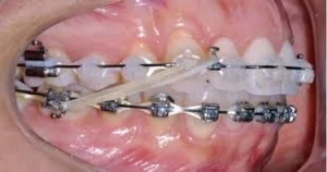 Cuidados preventivos para evitar a perda dentária em pacientes idosos Dentista em CIDADE DEZ.