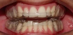 tratamento de canal para preservar dentes danificados ou infectado Dentista em CIDADE DEZ