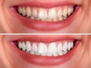 Tratamento de periodontite Dentista em CIDADE DEZ